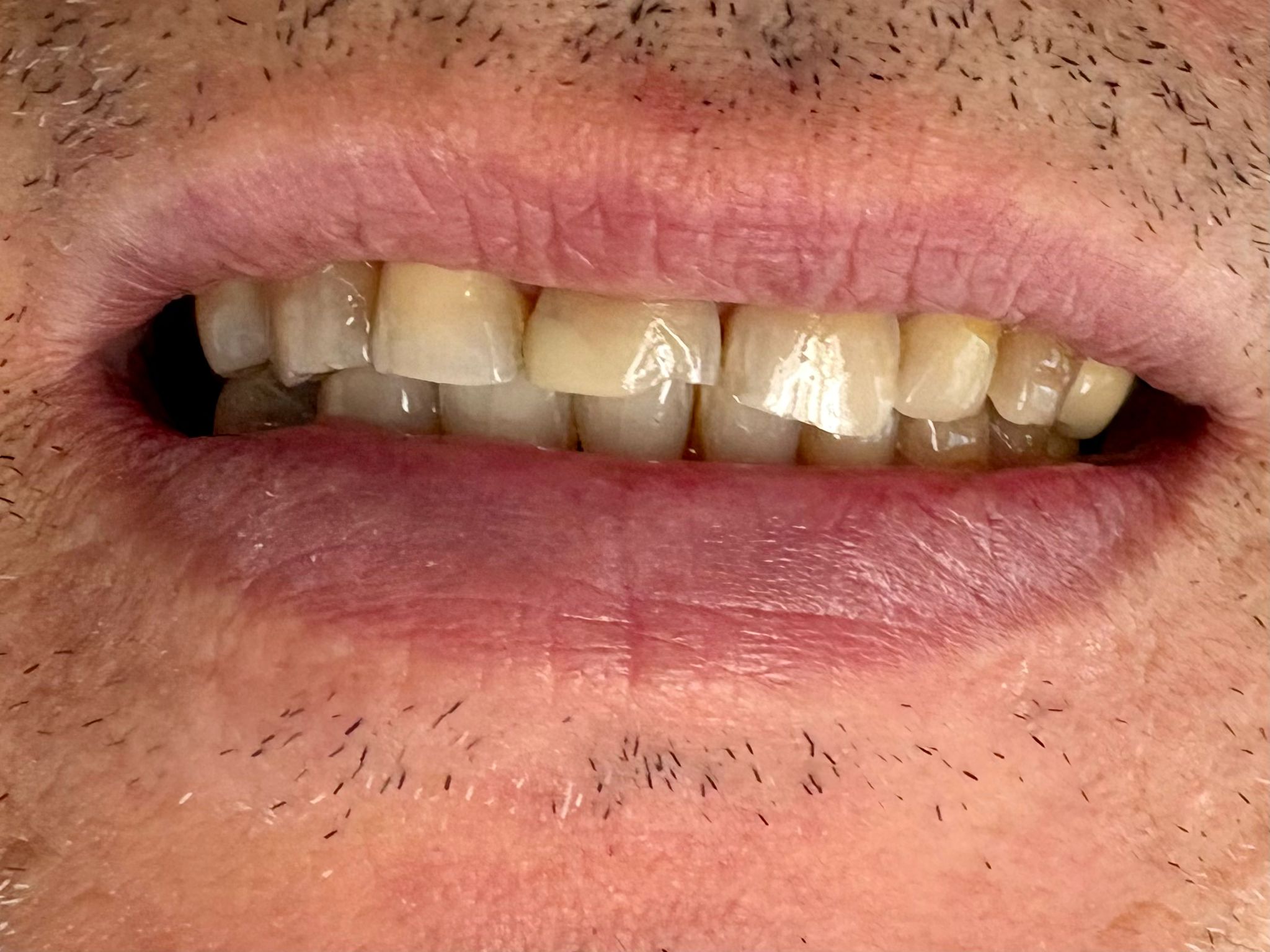 Prima – Injection Technique